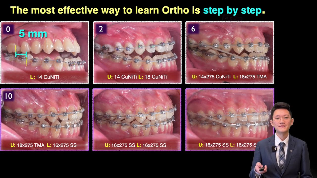 Class III open bite with facial asymmetry treated with Damon Ultima |【Chris Chang Ortho】CC828