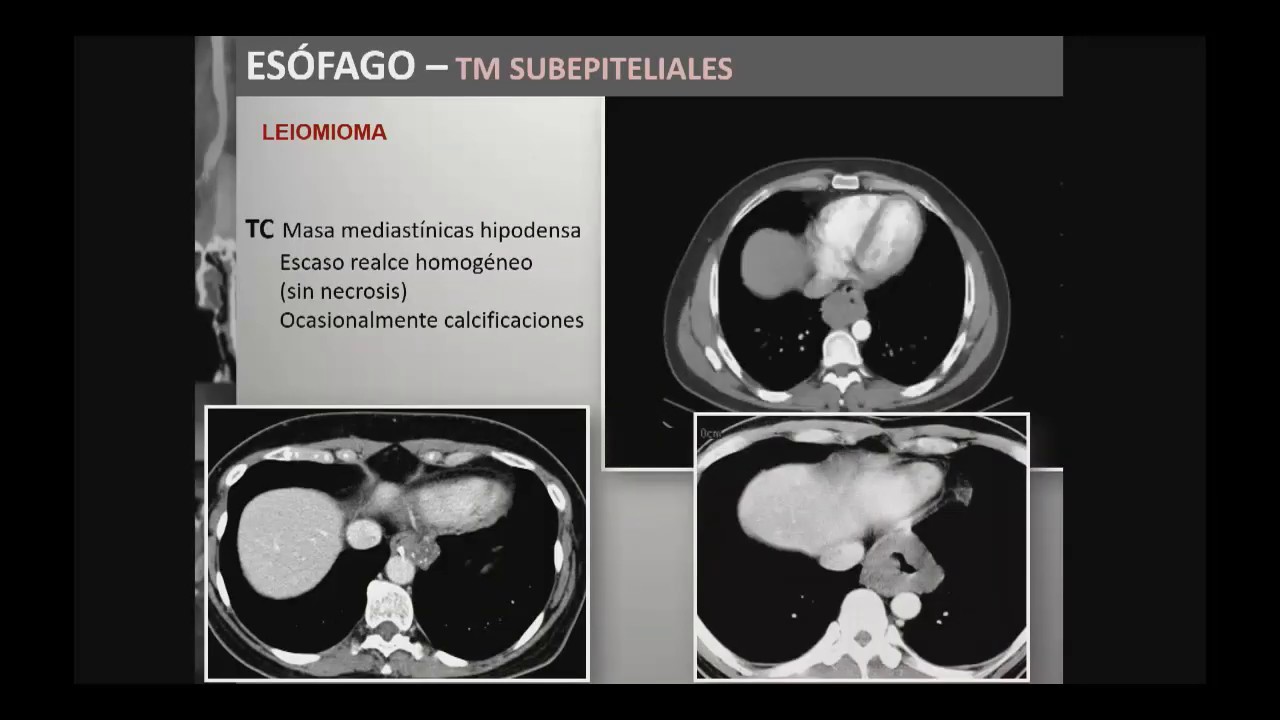 Tumores benignos de esófago y estomago. Características imagenológicas