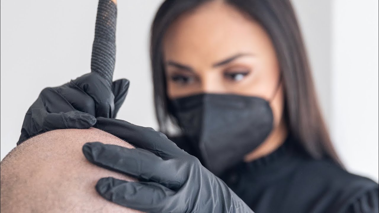 Injerto Capilar con MICROPIGMENTACIÓN CAPILAR