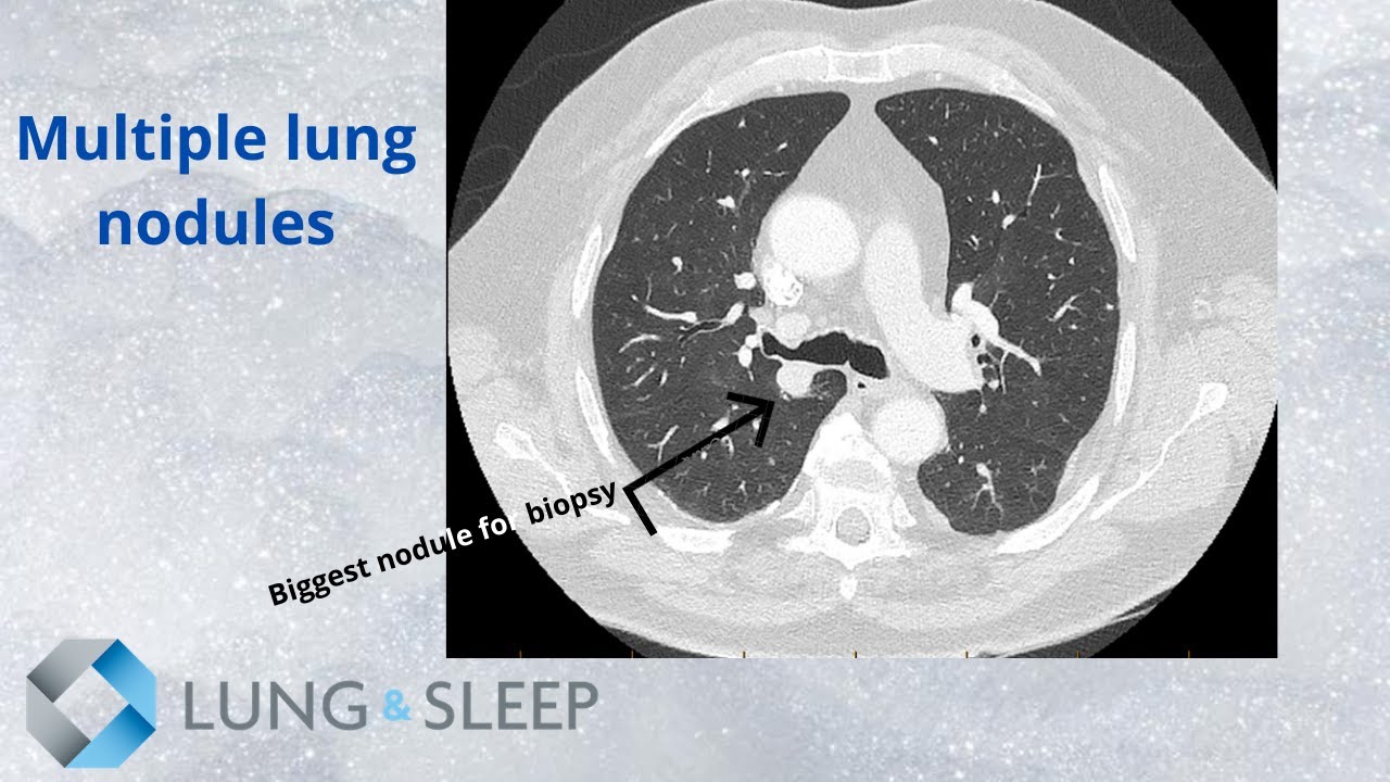 Multiple pulmonary nodules. Are they cancer?