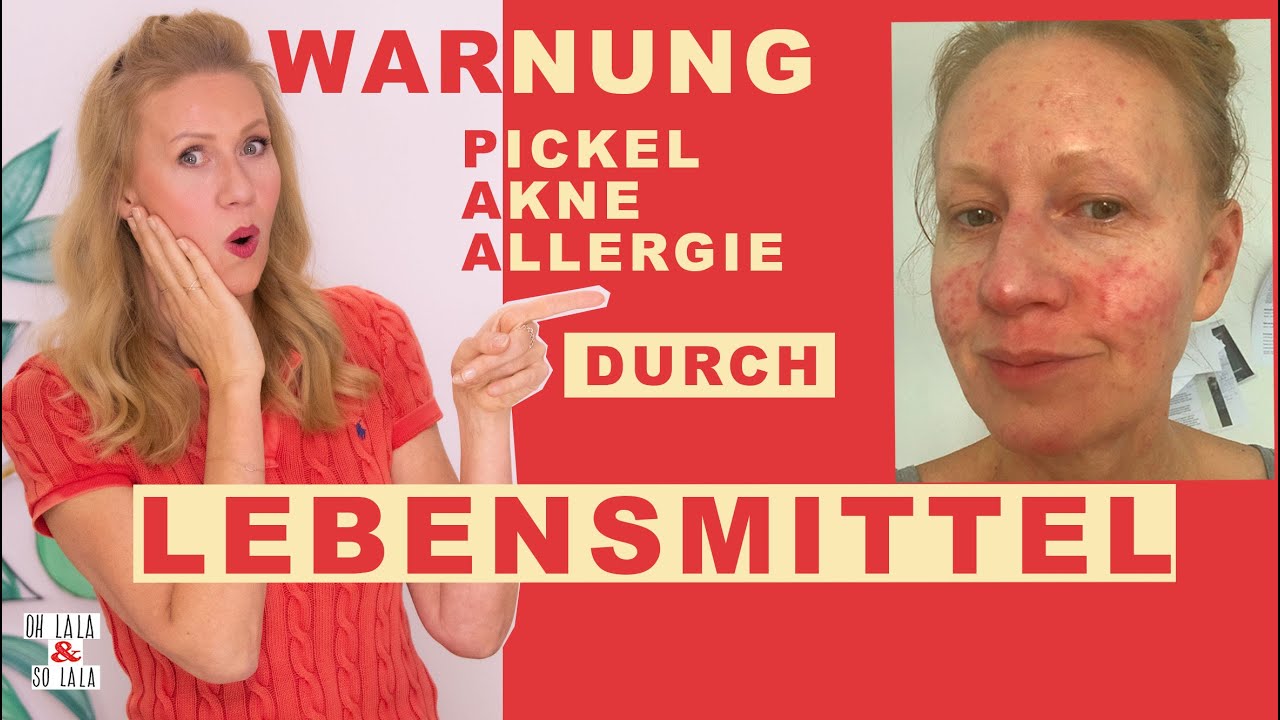ISS DAS NICHT❗️WARNUNG Stoffe in Lebensmitteln auf die ich reagiere  Akne & Darmentzündung & Rosacea