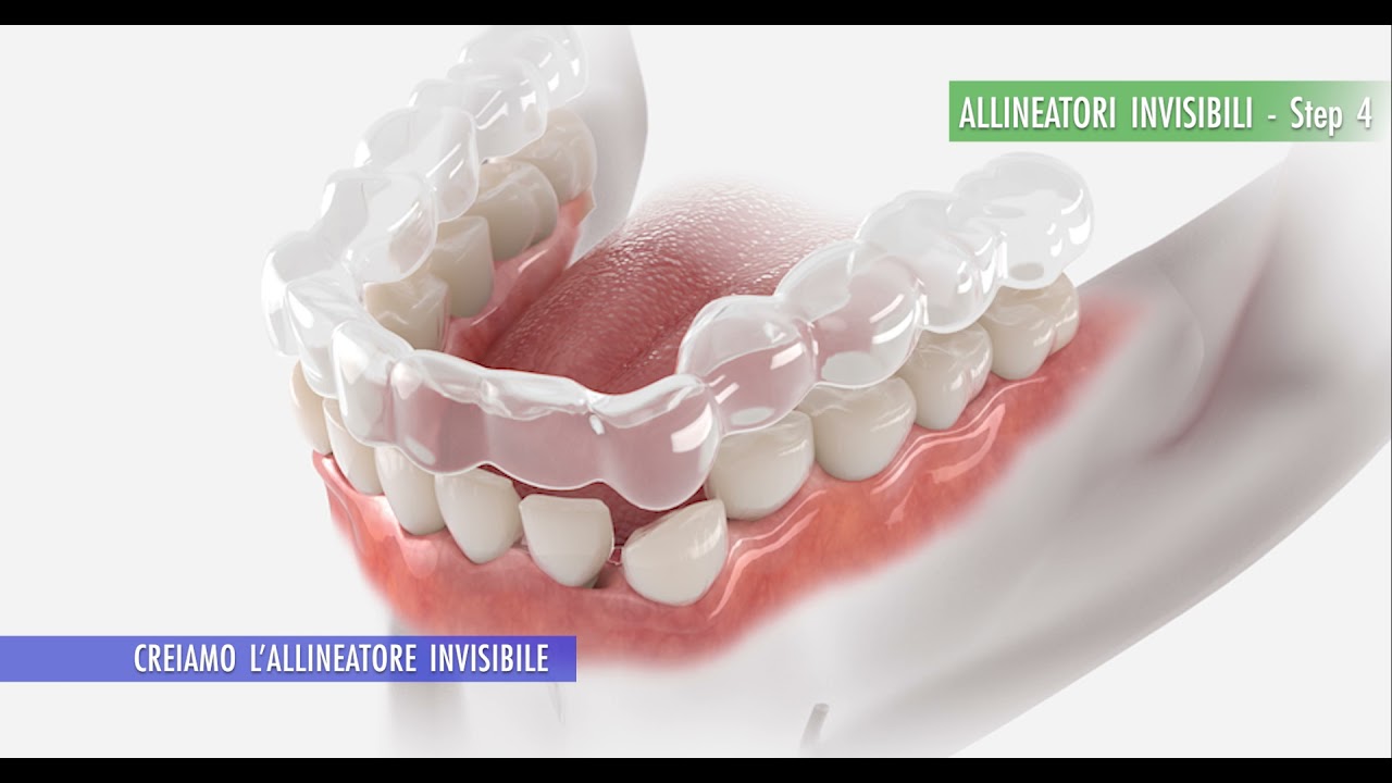 Centri Dental Smile (Oristano) - Allineatori Invisibili
