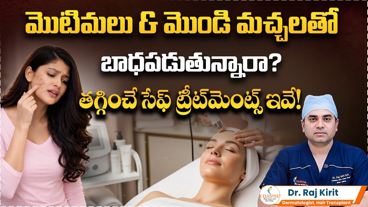 మొటిమలు మచ్చలు పోవాలంటే ఏం చేయాలి | How to Get Rid of Acne Scars? | Celestee Skin And Hair Clinic