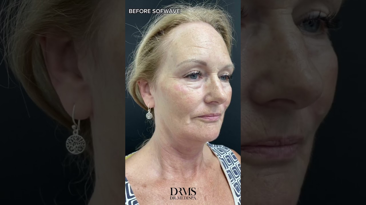 SOFWAVE Treatment Before & After Results | Dr. Medispa