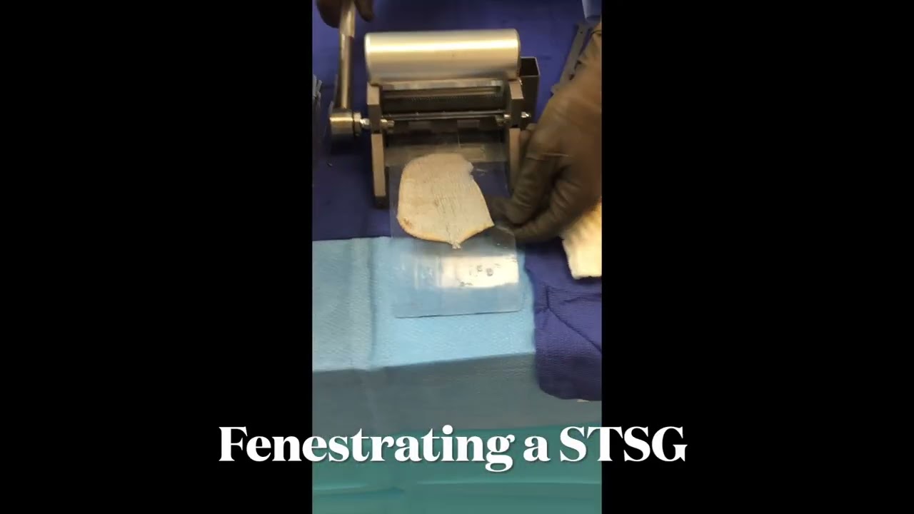 Meshing a Split-Thickness Skin Graft: Why It&rsquo;s Done!