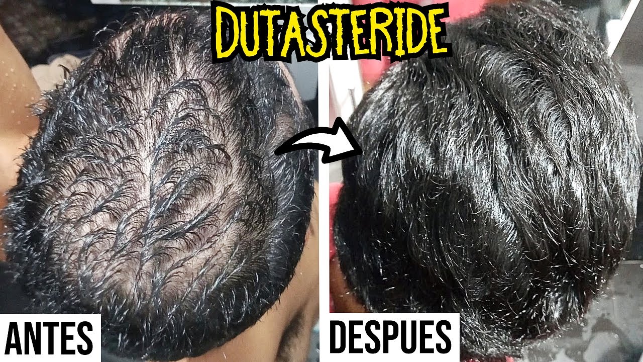 MINOXIDIL y DUTASTERIDE 4 Meses RESULTADOS para CAIDA DE CABELLO | Alopecia Androgenética CALVICIE