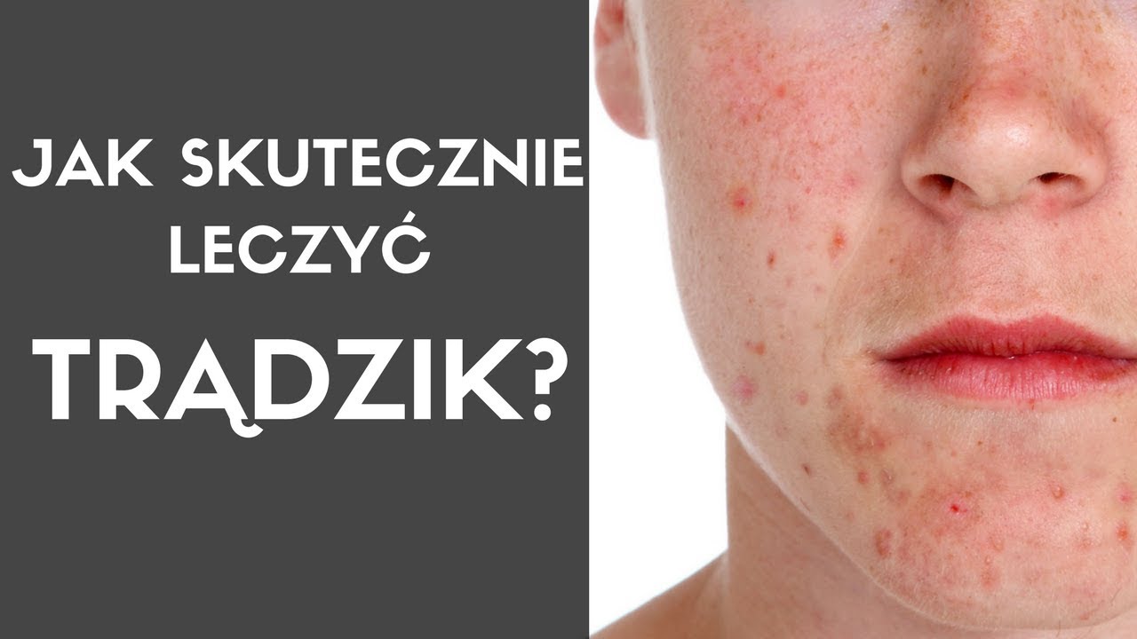 Jak skutecznie leczyć TRĄDZIK?