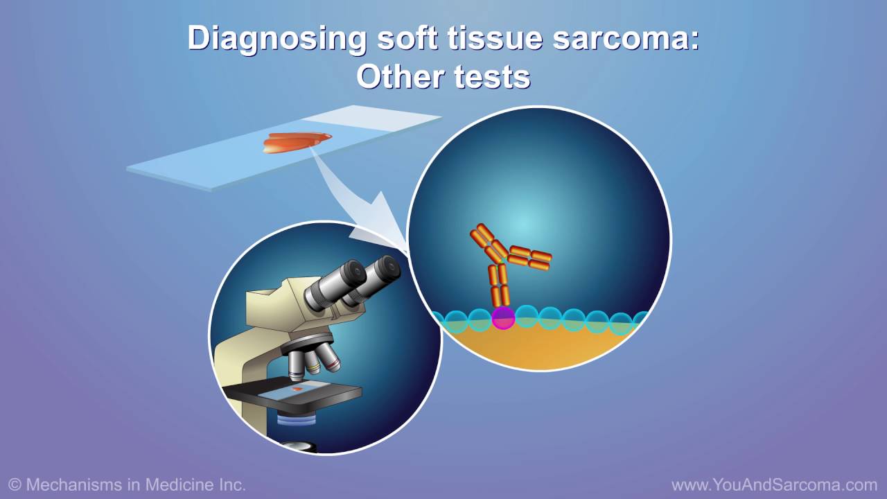 Diagnosing and Treating Soft Tissue Sarcoma