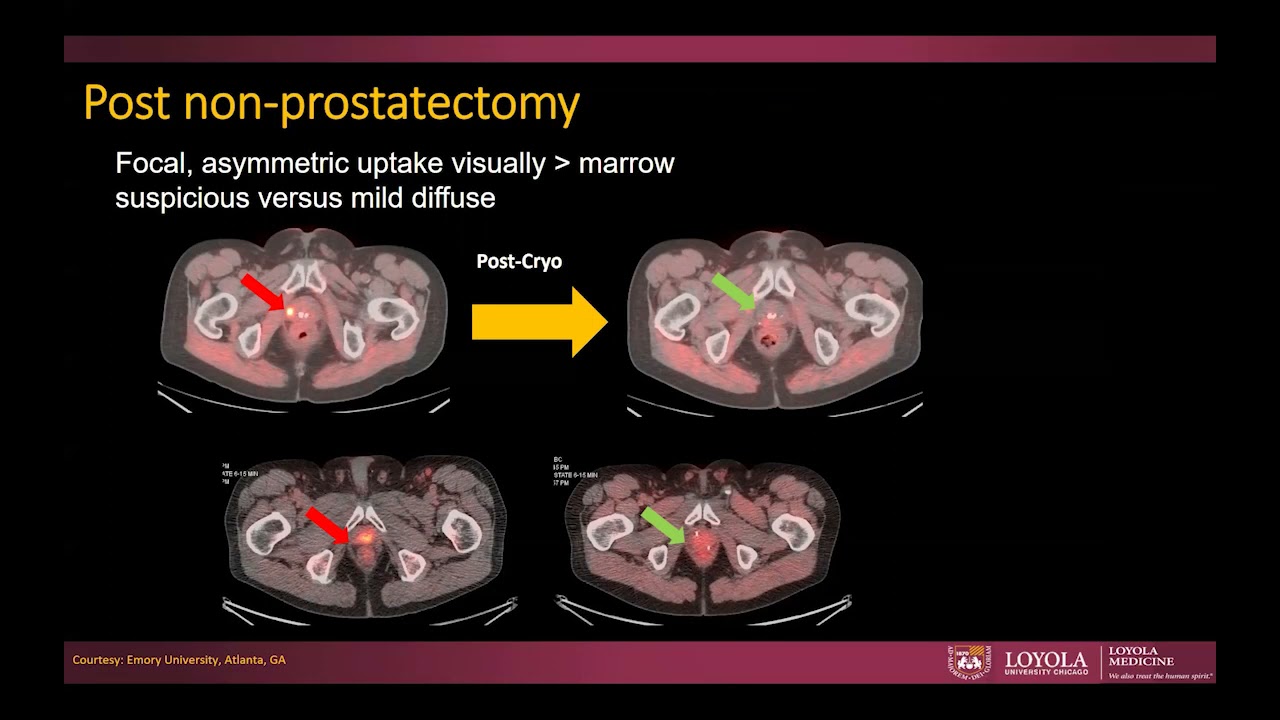 CT and PET CT in prostate cancer