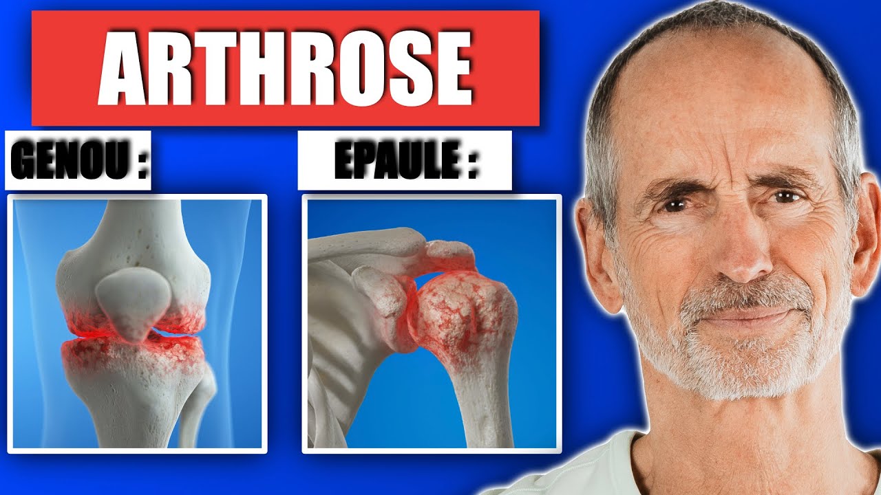 Personne ne vous dit ÇA à propos de l'ARTHROSE !