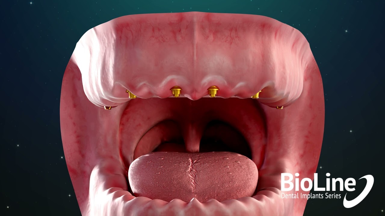 BioLine Multi-Unit Prosthetic Rehabilitation Protocol