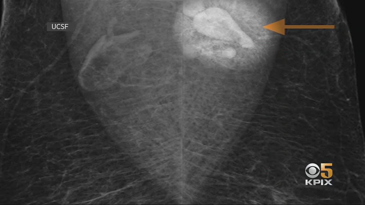 COVID: Swollen Lymph Nodes After Vaccination Could Lead To False Breast Cancer Diagnosis, UCSF Docto