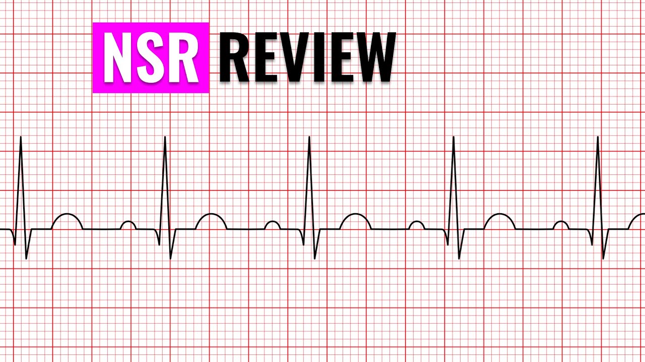 EKG NURSING QUICK REVIEW