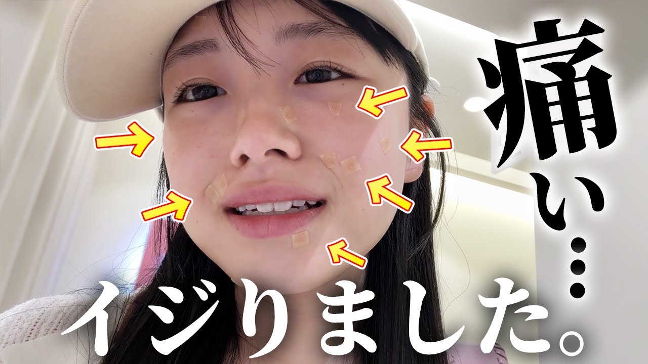 【ガチ垢抜け】激痛に耐え、韓国でイジってきました。。。1週間後のリアル経過も！🫢🇰🇷
