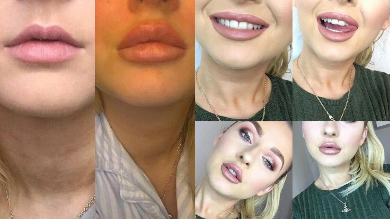 LIP INJECTION EXPERIENCE BEFORE AND AFTER !
