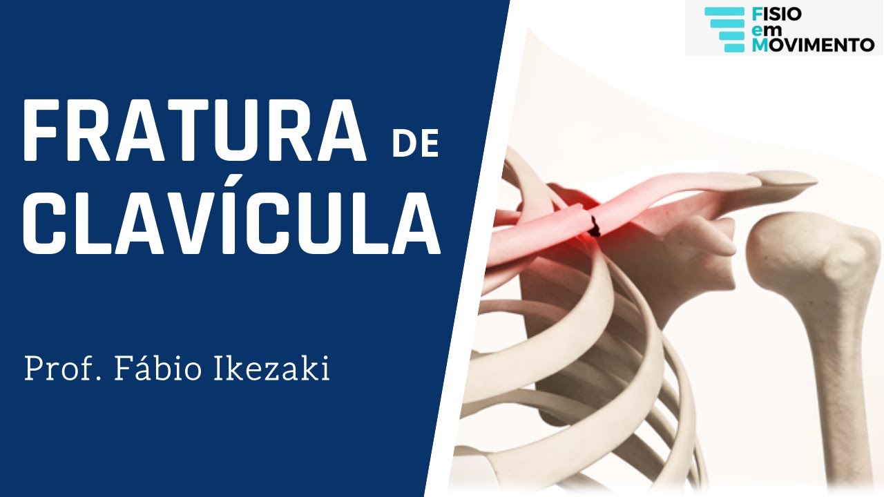 FRATURA DE CLAVÍCULA - FISIO EM MOVIMENTO