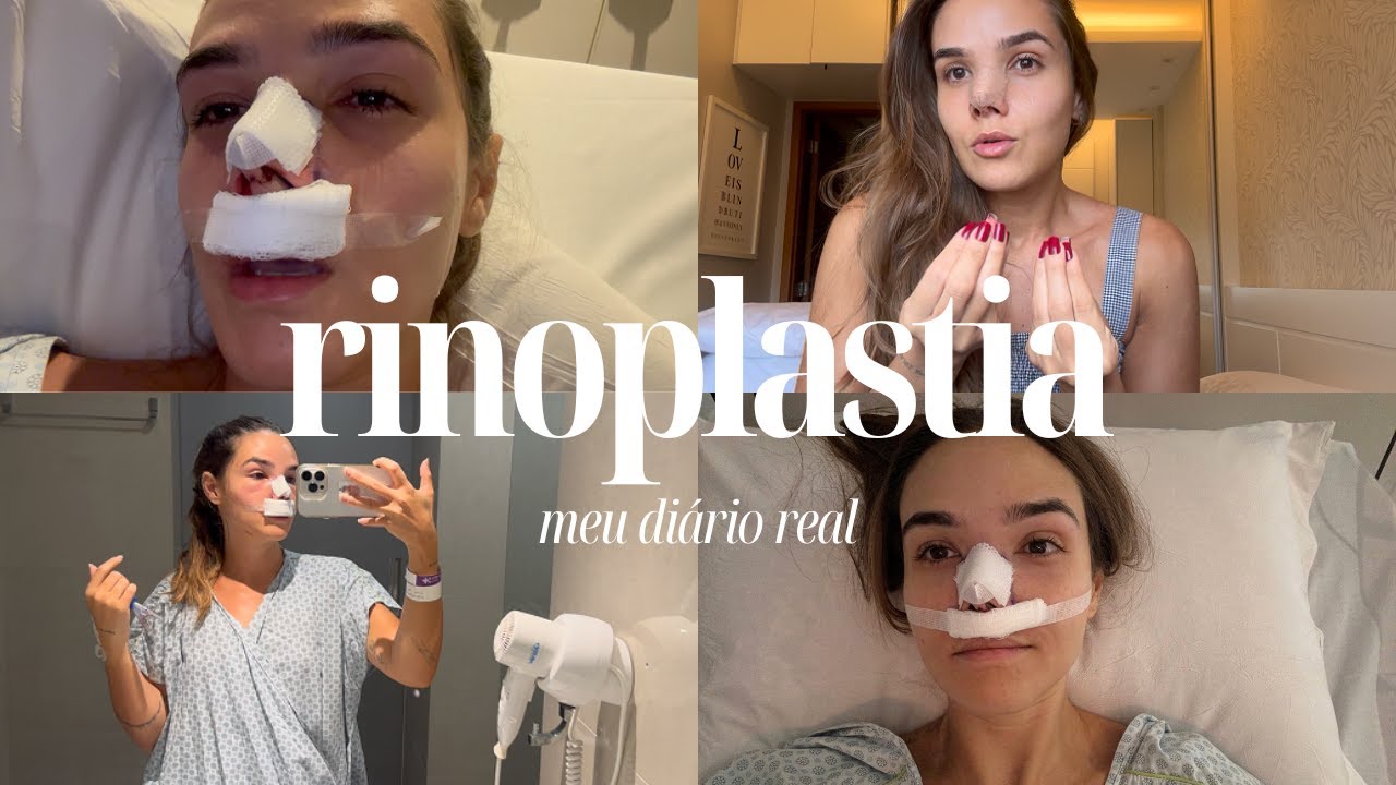 Diário real da minha rinoplastia