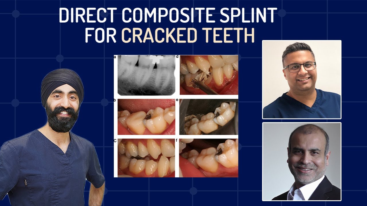 Cracked Teeth Management with the Direct Composite Splint Technique - PDP098
