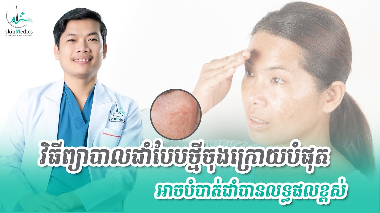 [មុខជាំ] ដុកទ័រប្រាប់វិធីព្យាបាលជាំ ដែលជួយឲ្យអ្នកជាំមុខឆាប់ទទួលបានលទ្ធផលខ្ពស់បំផុត មិនពិបាកដូចមុនឡើយ