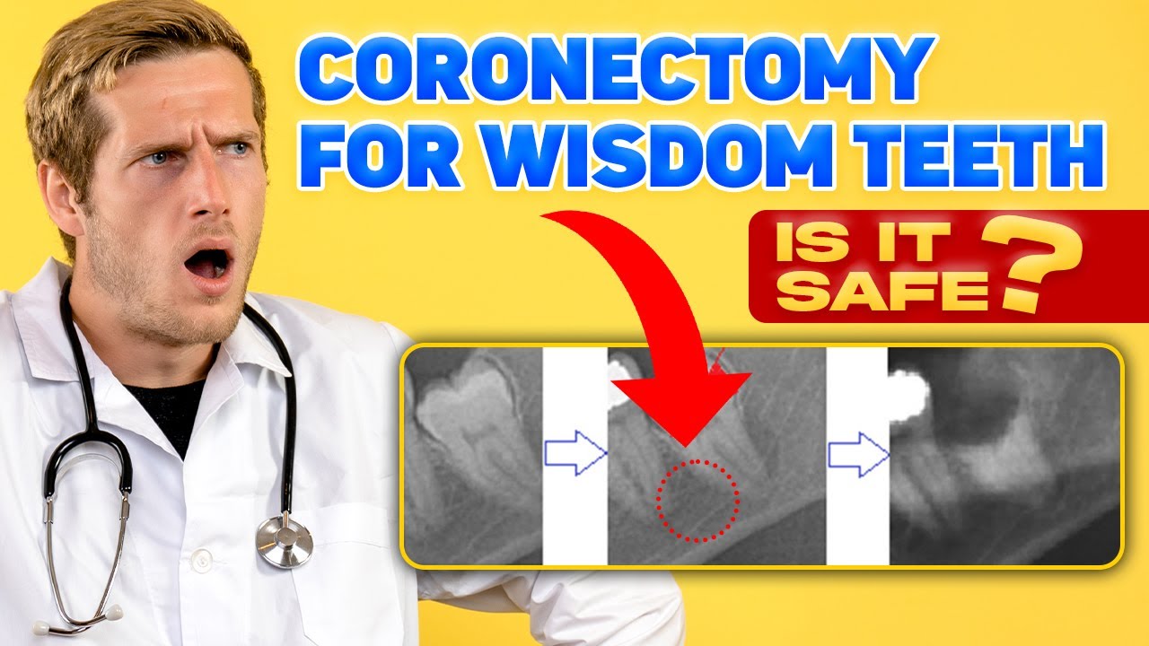 🦷 Coronectomy for Wisdom Teeth: Is It Safe? 🤔