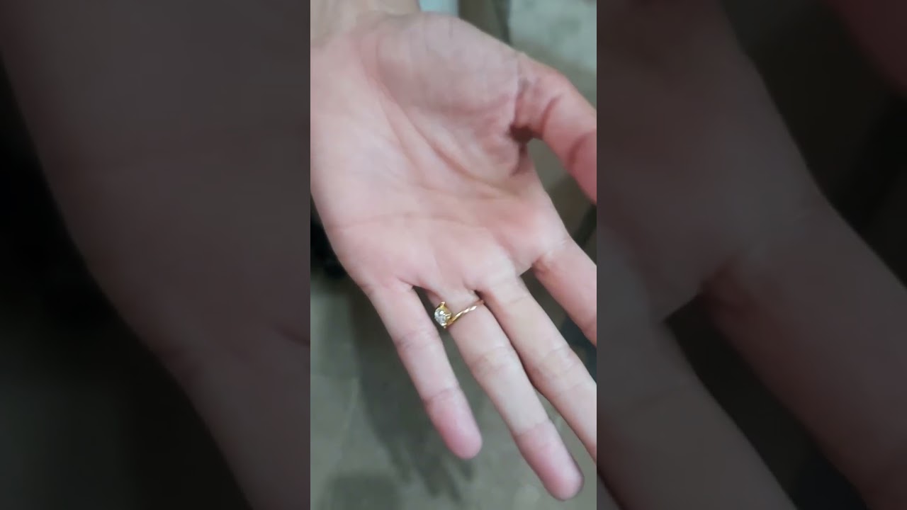 Thumb sign positive in marfan syndrome