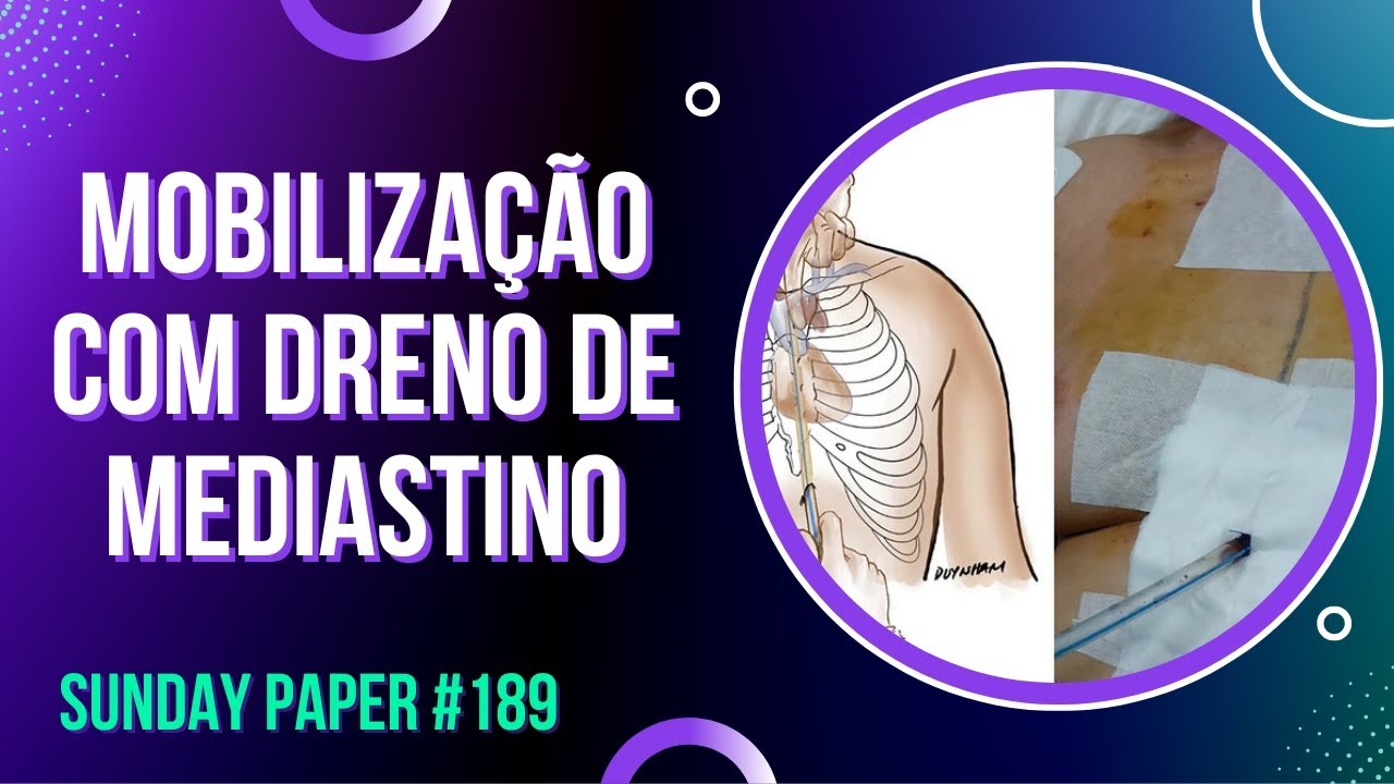 Posso Mobilizar Pacientes com Dreno de Mediastino? #189 - SUNDAY PAPER | Ivens Giacomassi