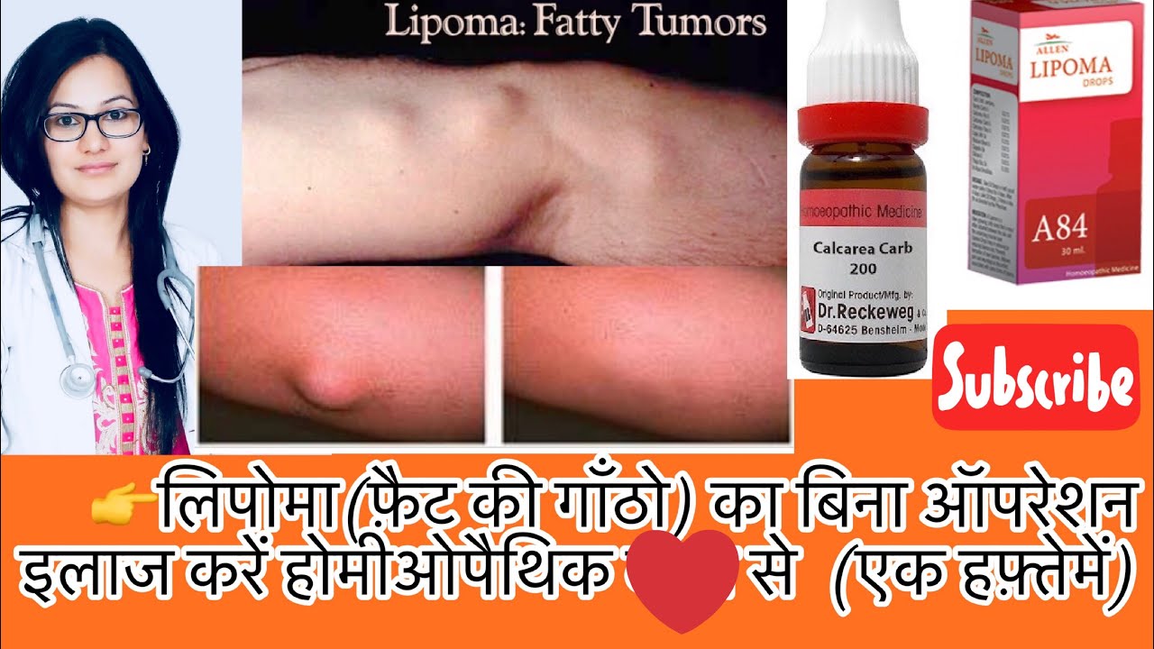 फ़ैटीFatty Tumor (चरबी की गाँठे)-What is Lipoma? Cause Of Lipoma??-By-डाक्टर रुक्मणी Choudhary