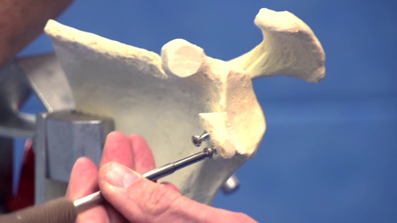 Latarjet Procedure / Shoulder Surgeon Dr David Colvin Perth