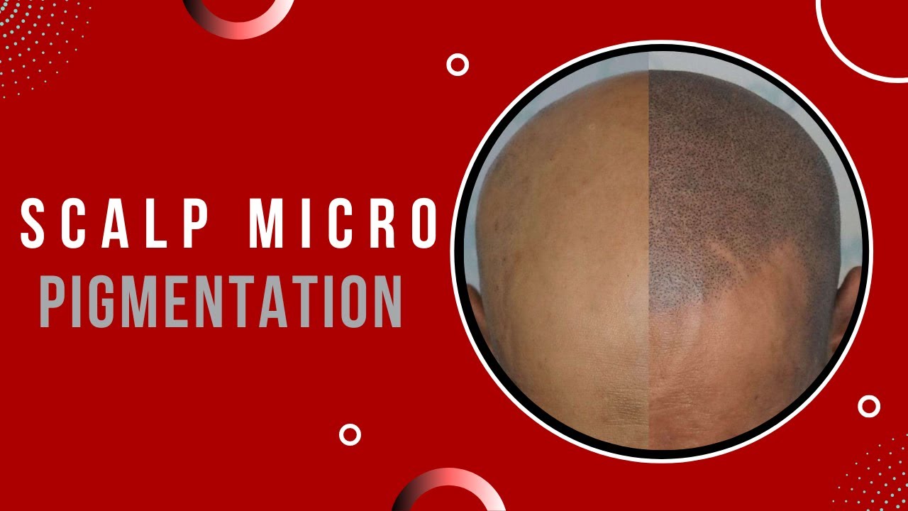 Scalp Micro Pigmentation (SMP) | SMP Treatment | Hair Destination