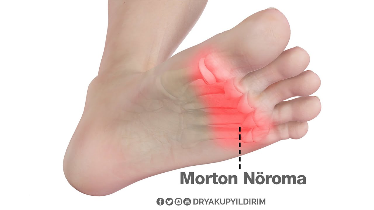 Morton Nöroma Hakkında Bilinmesi Gerekenler | Prof. Dr. Yakup YILDIRIM