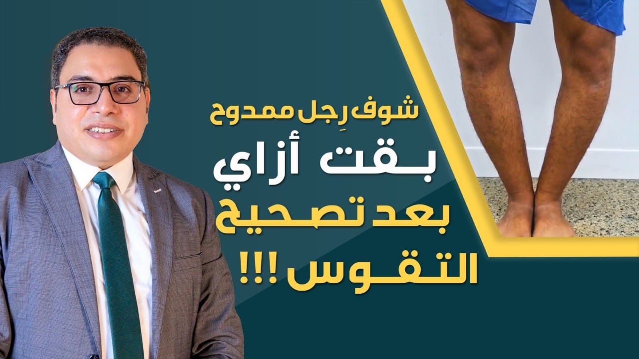 من العرج إلى الاستقامة.. شاهد تحول شكل الساق اليسرى قبل وبعد!
