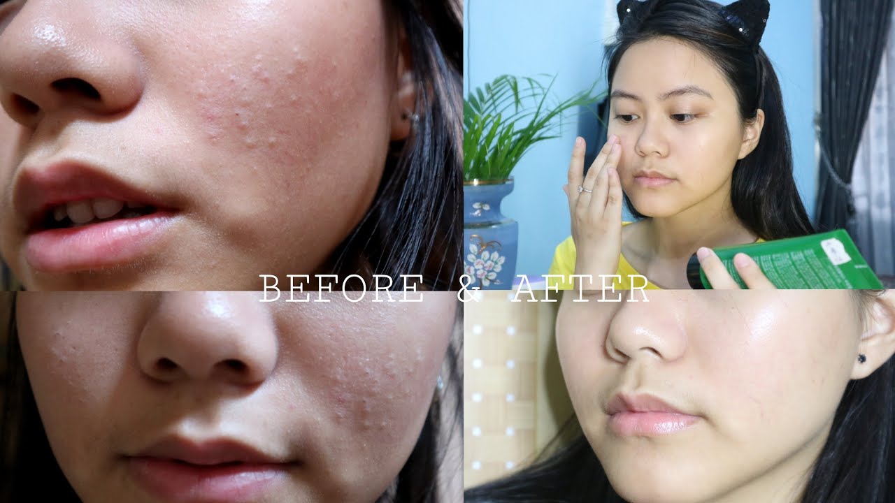 Basic & Minimal Skicare Routine (BERUNTUSAN/FUNGAL ACNE/malassezia folliculitis)