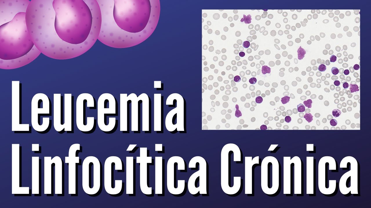 Leucemia Linfocítica Crónica
