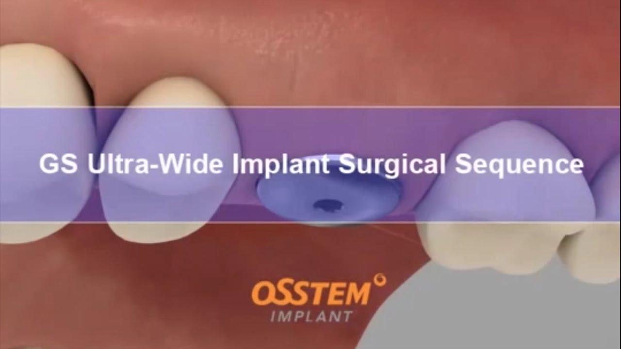 TS III Ultra-Wide implant.  Три варианта установки