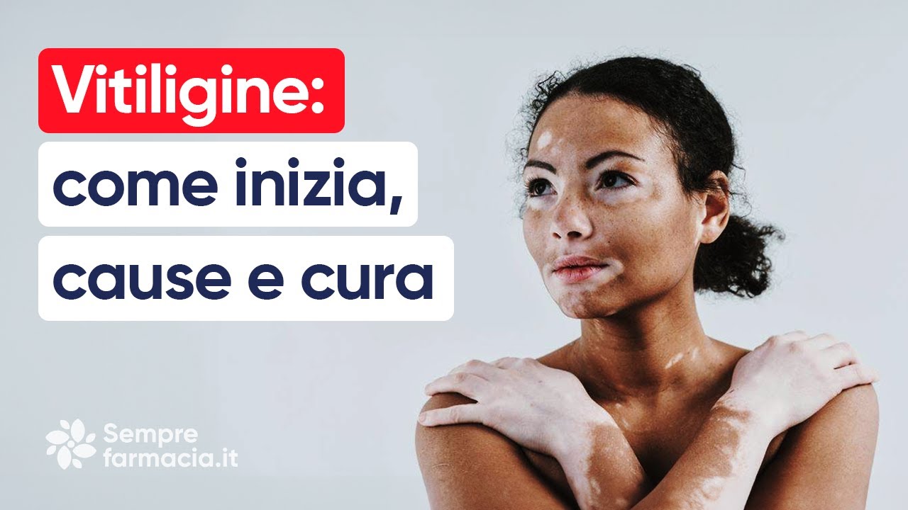 Vitiligine: come inizia, cause e cura