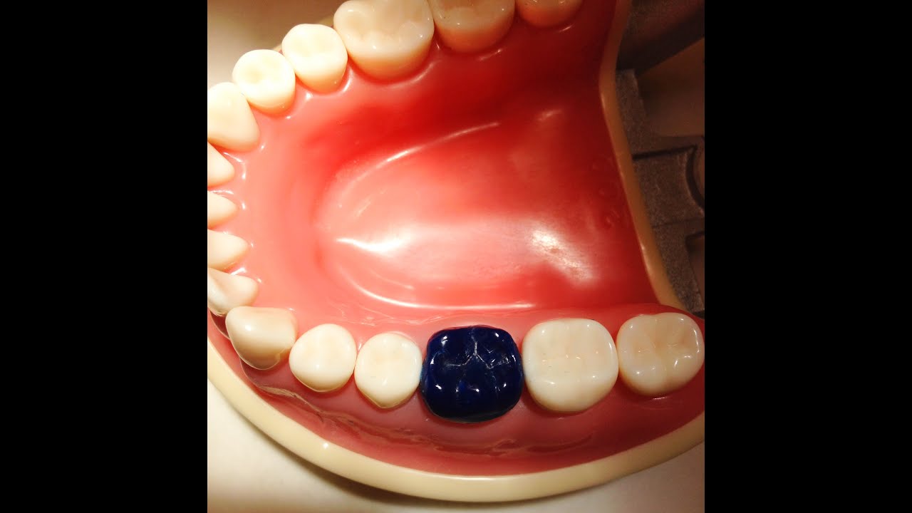 Tooth #19 full contour wax up