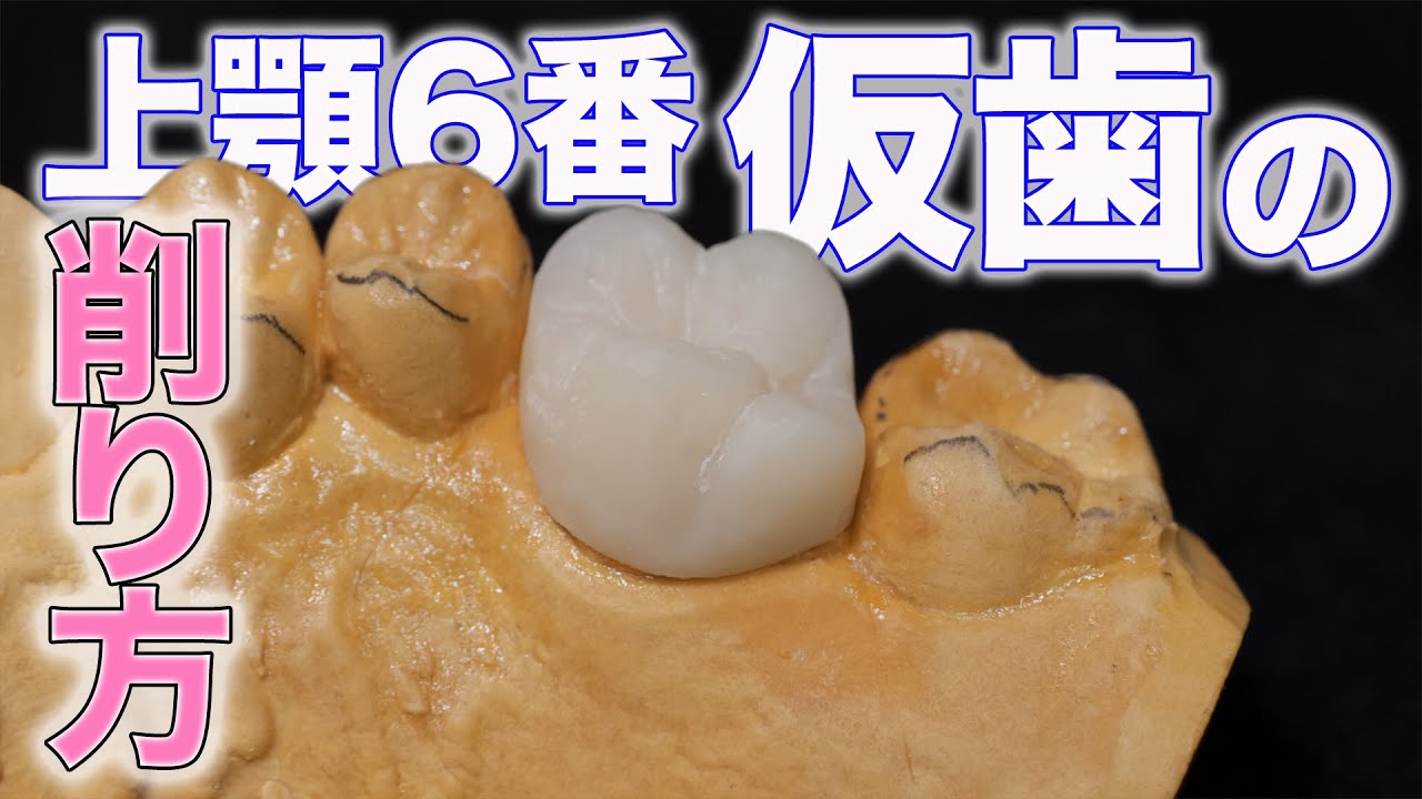衛生士さんにも観て欲しい！上顎6番の削り方