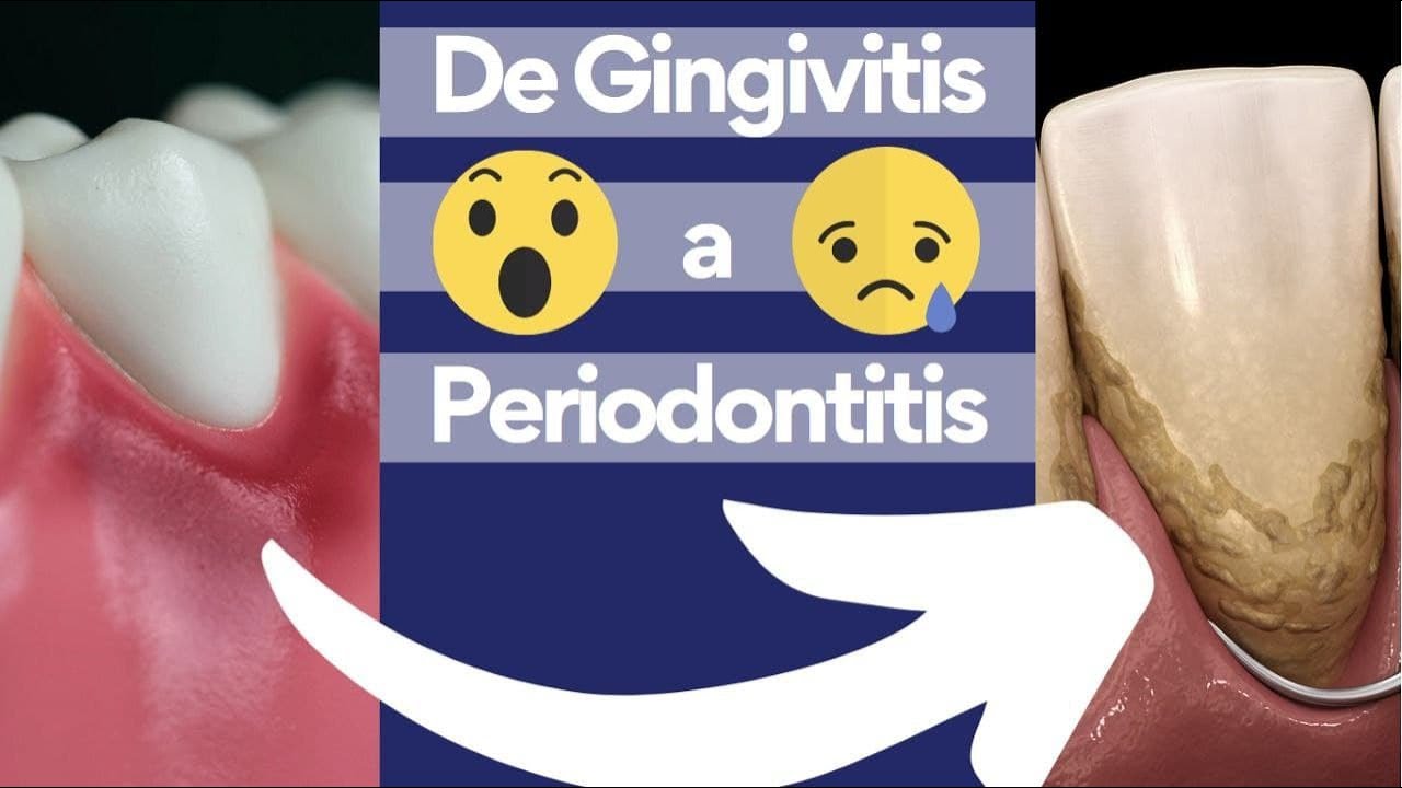 De gingivitis a periodontitis: Como nuestra salud de las encías puede llevarnos a perder dientes