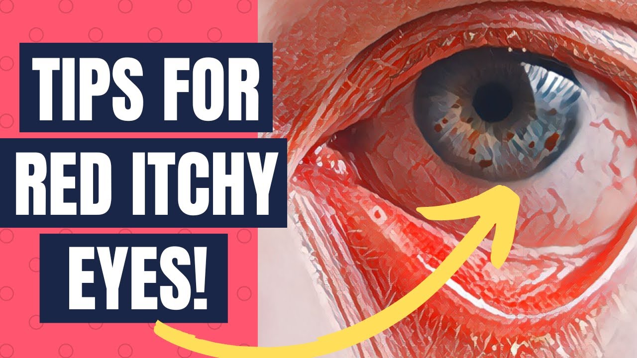 How To Get Relief From Allergic Conjunctivitis or Itchy Red Eyes