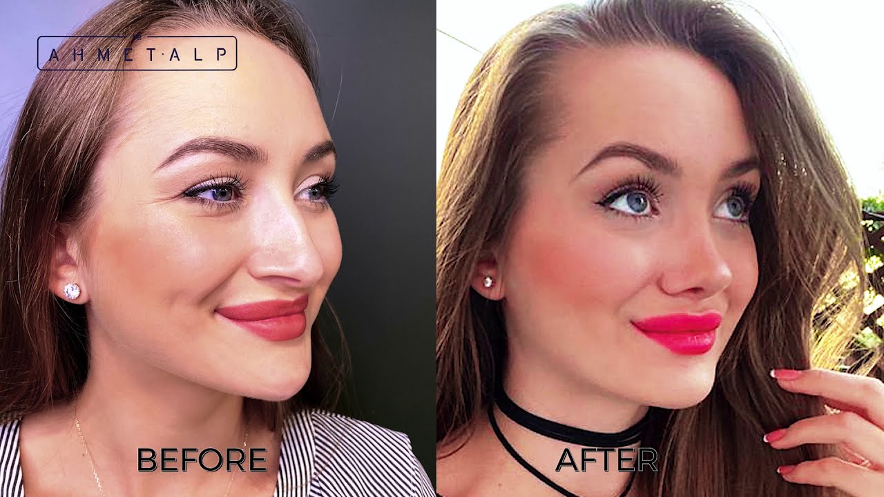 Rhinoplasty Surgery in Istanbul