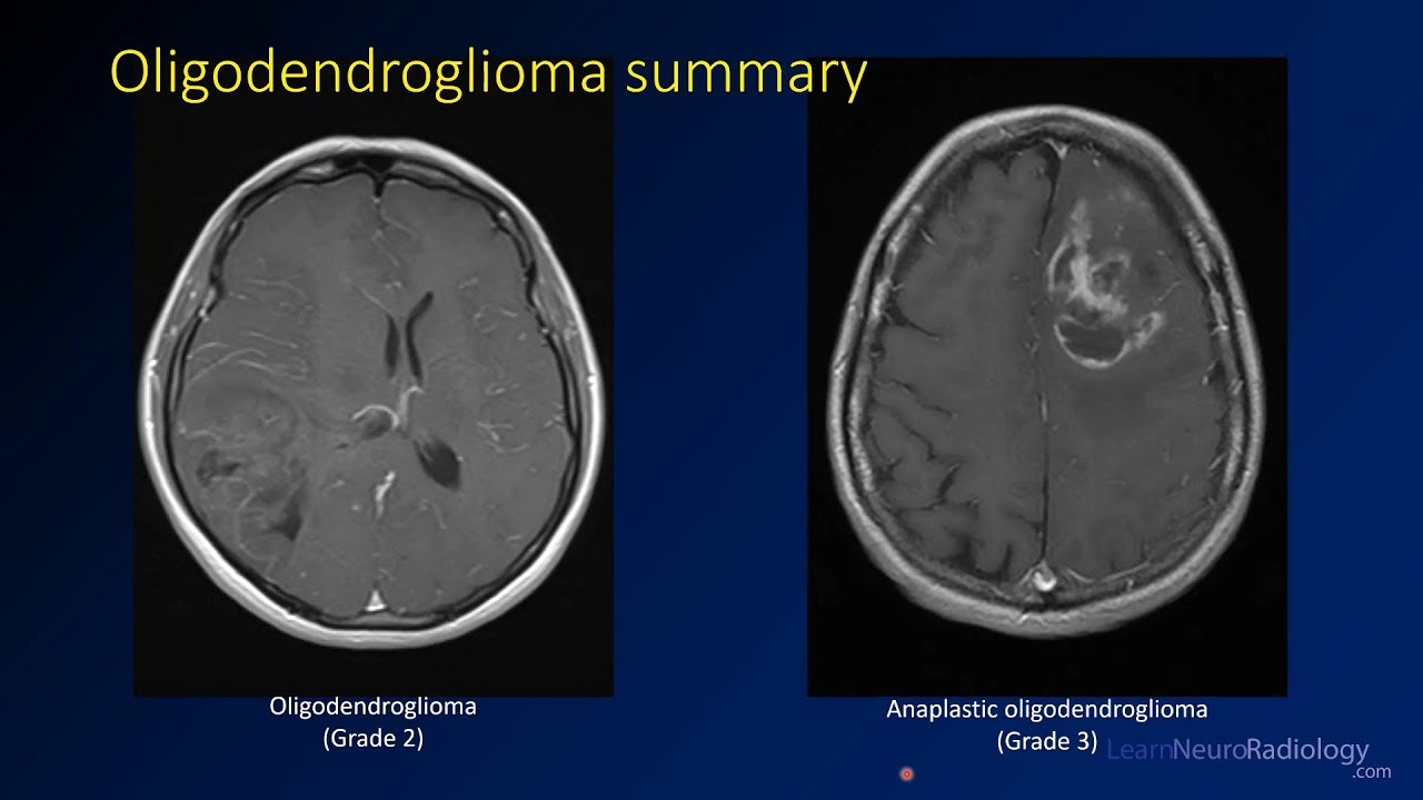 Imaging brain tumors - 3 - Oligodendrogliomas