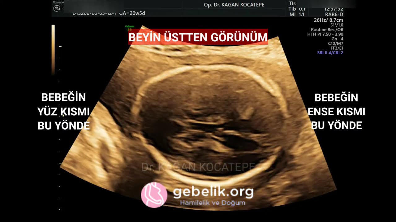 21.GEBELİK HAFTASINDA BEBEĞİN BEYİN İÇİ YAPISI NASILDIR? ENSE KALINLIĞI VE VENTRİKÜL KAÇ MM. OLMALI?