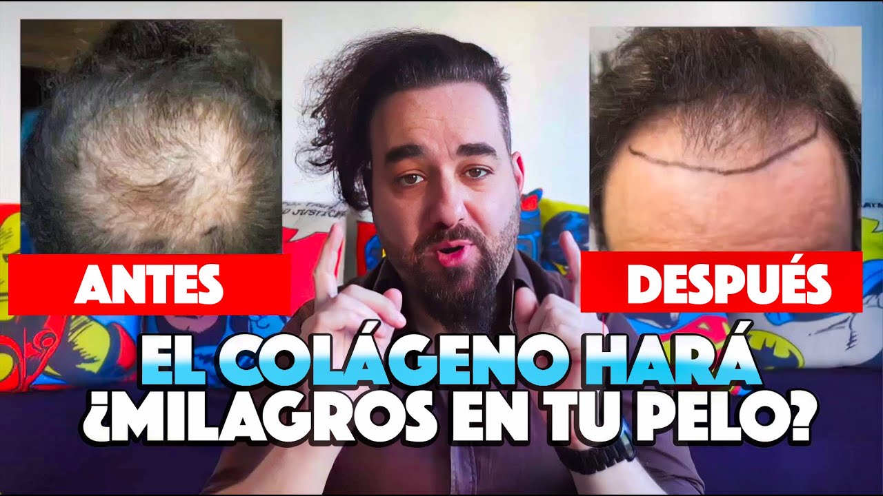 El Milagro del Colágeno Puede sustituir un Injerto Capilar 🤔