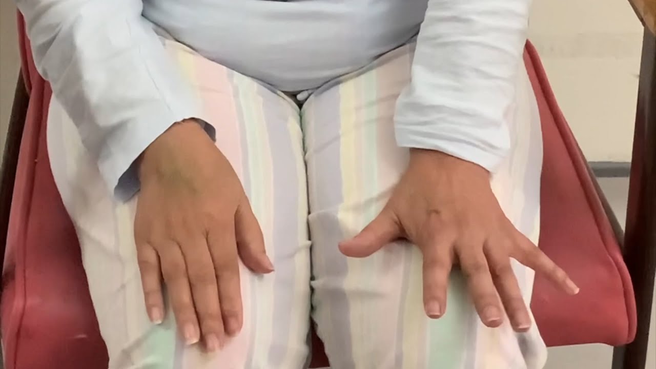 Alternate Hemibody Hyperkinetic and Hypokinetic Movement Disorders Due to Cerebral Toxoplasmosis