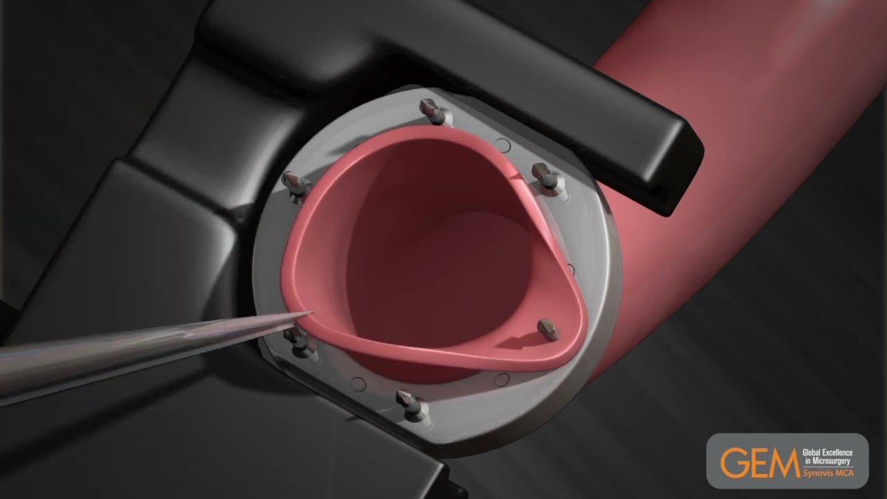 Microvascular Anastomotic GEM COUPLER Device Instructions for Use