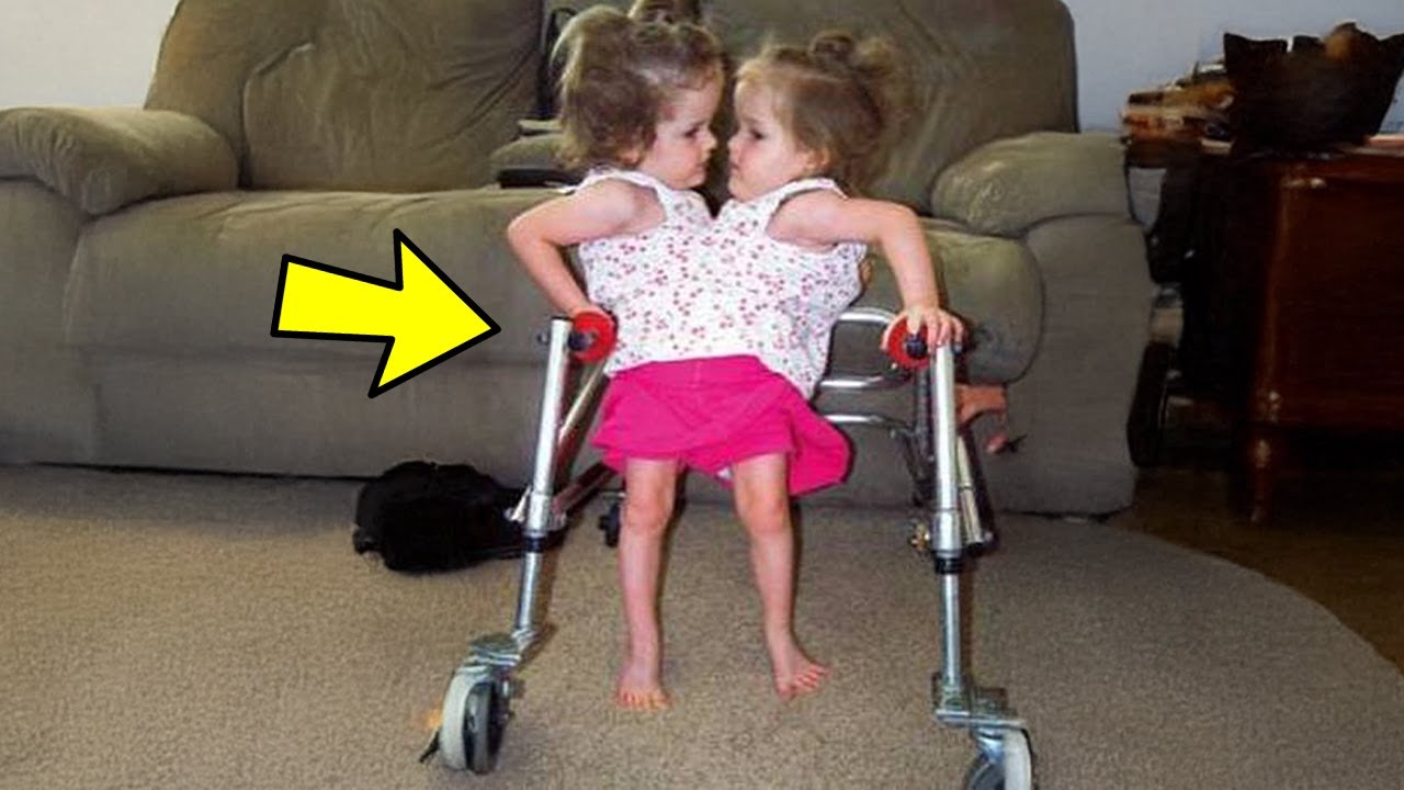 Remember These Conjoined Twins Separated 18 Years Ago? You Won’t Believe What They Look Like Now!