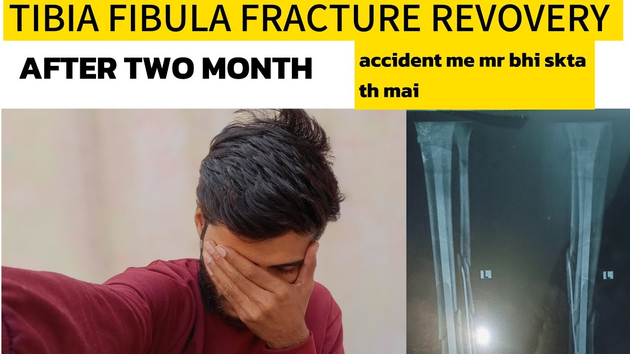 Finally full weight dalkr chlne lga Tibia fibula bone recovery time Accident m hddi tut gyi ll ####