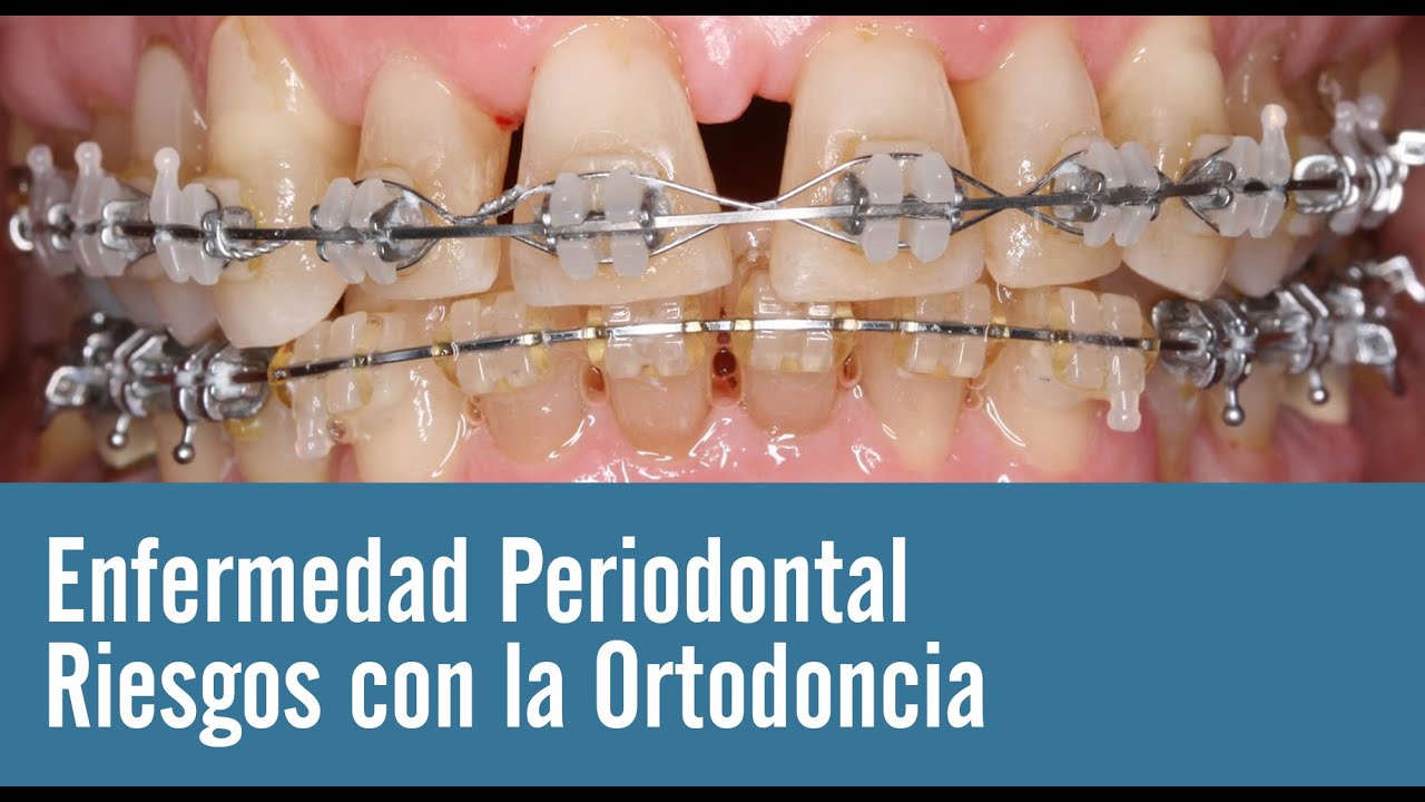 Ortodoncia y salud periodontal | Juan Salgado |  enfermedades periodontales