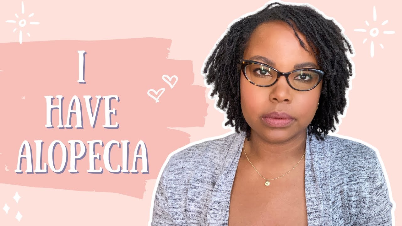 Sisterlocks Update: I Have Alopecia 