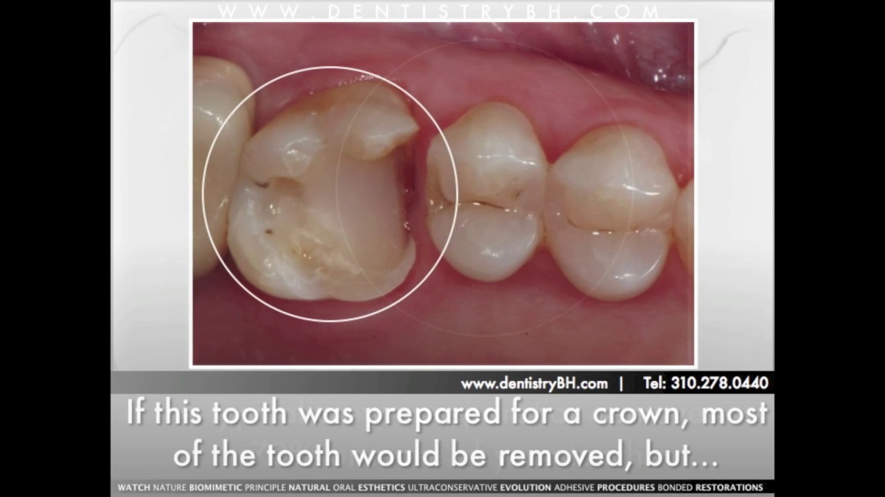 Biomimetic Dentistry Prevents the Tooth Cycle of Death